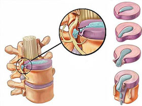Bel Fıtığı ve Tedavi Yöntemleri