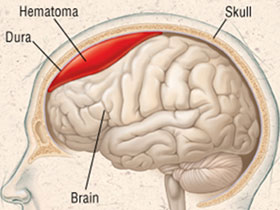 Travma Sonucunda Beyinde Kanama: Epidural Hematom