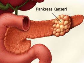 Pankreas Kanseri